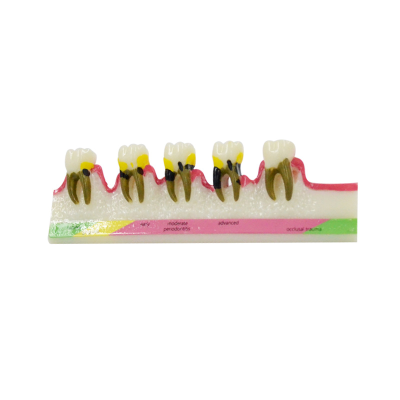 Medical Lab Study - Modell für Parodontitis Modell für Dental